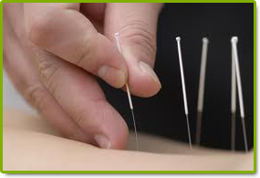 Acupuncture